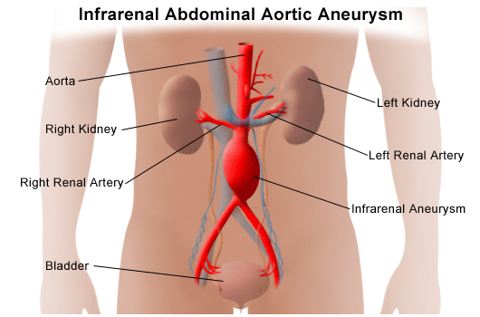 Abdominal Aortic Dissecting Abdominal Aortic Aneurysm