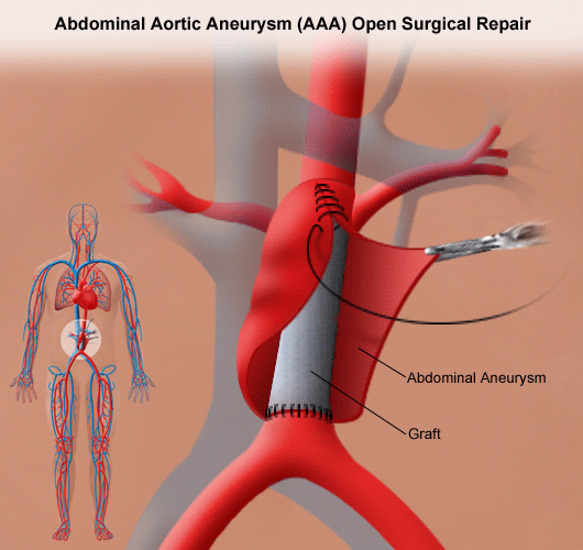 Abdominal Aortic Aneurysm Open Repair