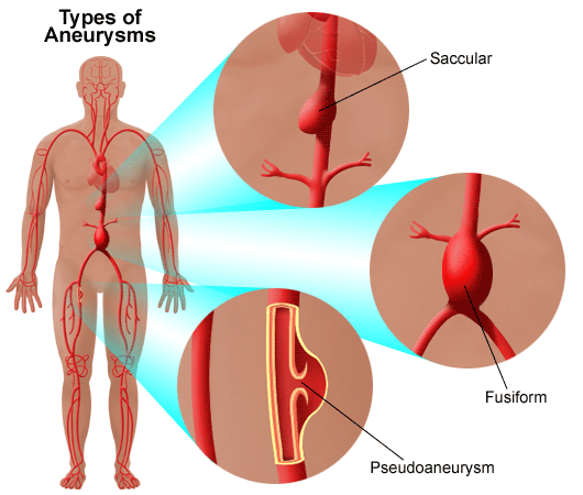 Types Of Thoracic Aortic Aneurysm Taa Stanford Health Care