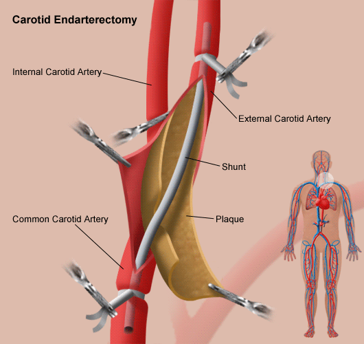 Medical Treatments For Carotid Artery Disease Stanford Health Care