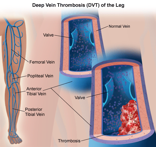 What is deep vein thrombosis?