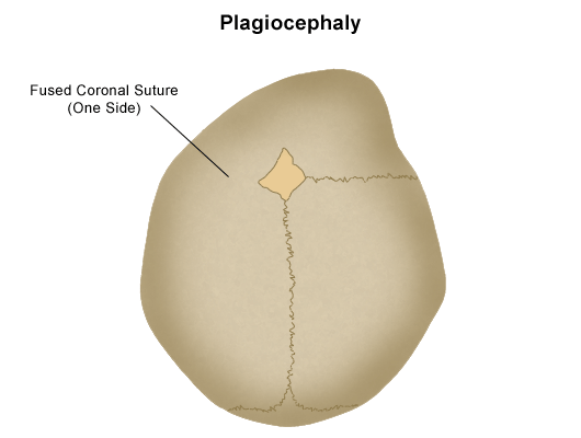 anterior plagiocephaly