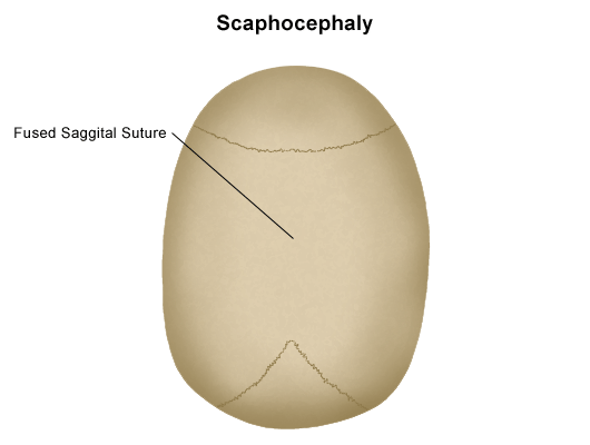 scaphocephaly