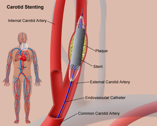 Carotid angioplasty and stenting