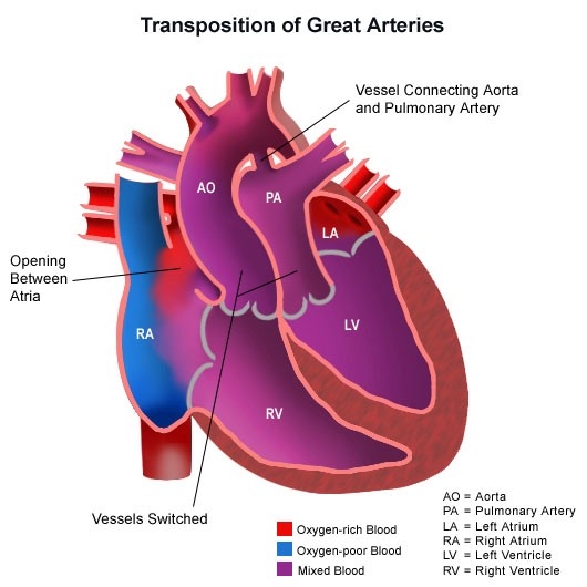 congenitalheartdisease-diagram-heartarteriestransposition.jpg