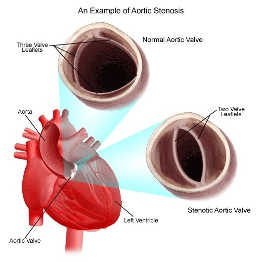 congenitalheartdisease-diagram-heartaorticstenosis.jpg