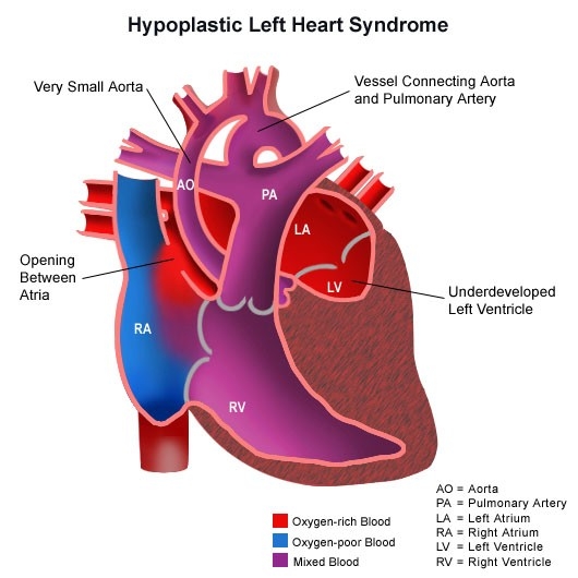 congenitalheartdisease-diagram-hearthypoplastic.jpg