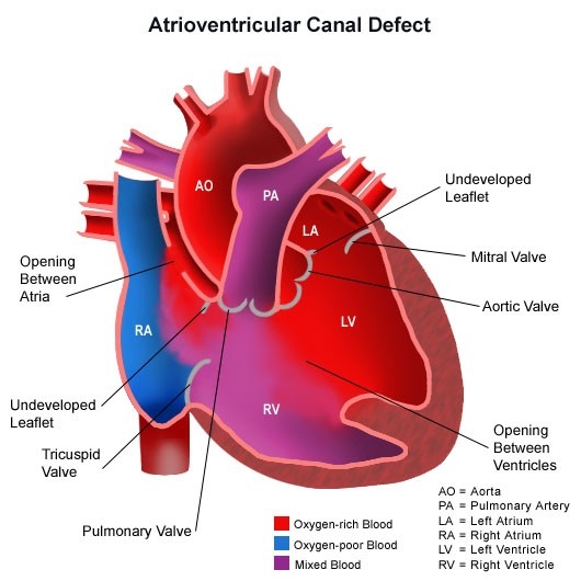 congenitalheartdisease-diagram-heartcanaldefect.jpg