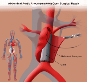 Abdominal Aortic Aneurysm (AAA) Open Repair