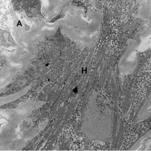 Electron microscopy shows amyloid deposits in normal heart muscle