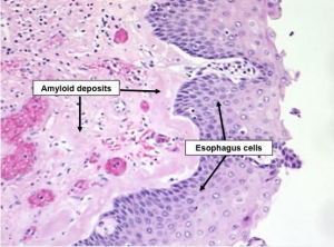 Amyloid deposits are seen in the esophagus of a patient