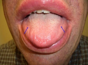 Amyloid deposits in the lip and tongue