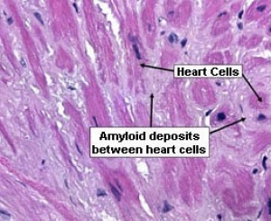 AL primary amyloidosis in the heart