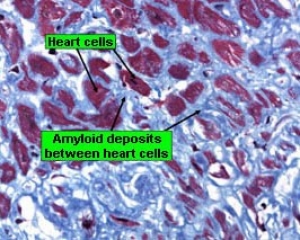 AL primary amyloidosis in a heart