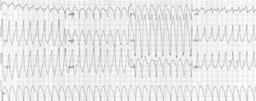 Right Ventricular Outflow Tract Tachycardia