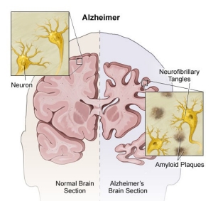 An image of a brain affected by Alzheimer’s disease. 