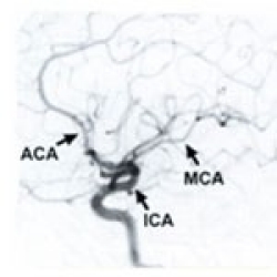 middle cerebral artery angiogram