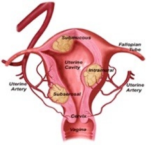 Women’s reproductive system with different types of fibroids