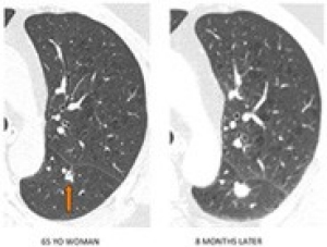 Lung cancer detection with computed tomography (CT scan)