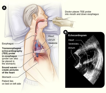 Transesophageal Echocardiogram (TEE) | Stanford Health Care