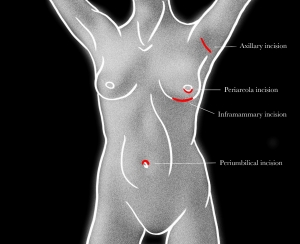 breast augmentation incisions