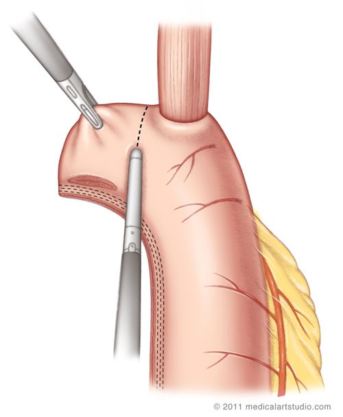 diagram of completion of the Esophago-Gastric Anastomosis
