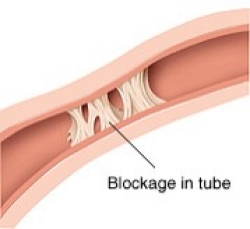 Blockage in fallopian tubes
