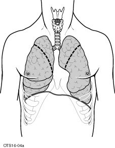 diagram of typical areas of lung removed during LVRS