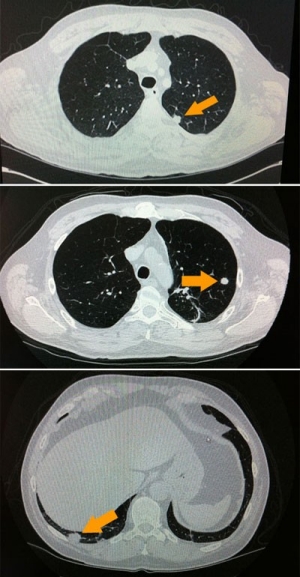 CT images of lung nodules