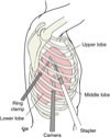 diagram of video-assisted thoracic surgery (VATS)