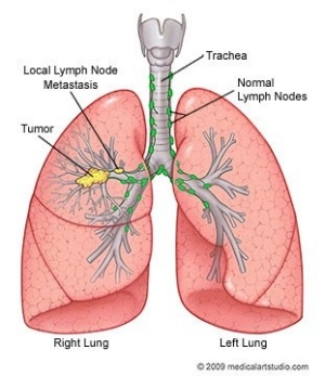 diagram of lung cancer